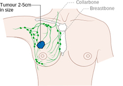 New Methods for Breast Cancer Screening | Ask A Biologist